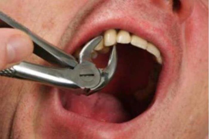 بريطانيا.. رجل يخلع أسنانه باستخدام كماشة بسبب الغلاء