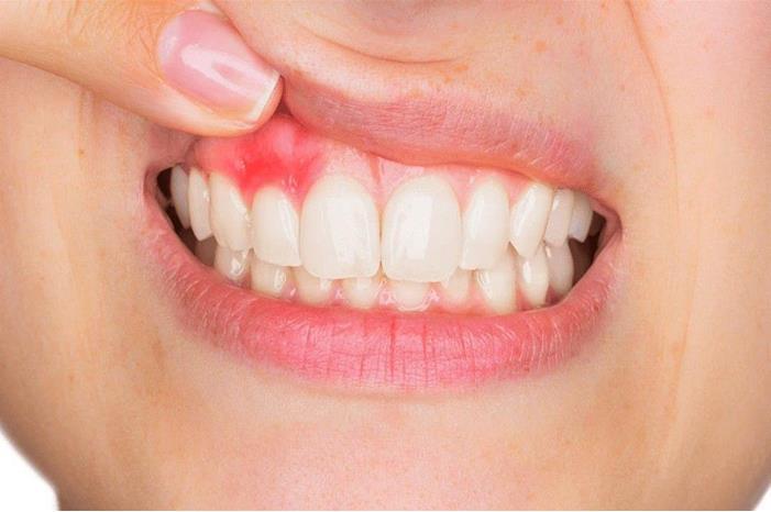 طرق علاج التهاب اللثة