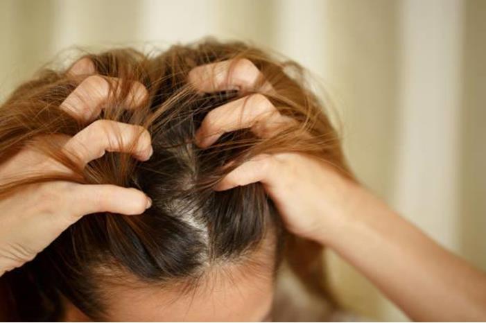 علاج صدفية الشعر لكِ في المنزل وبمكون سهل