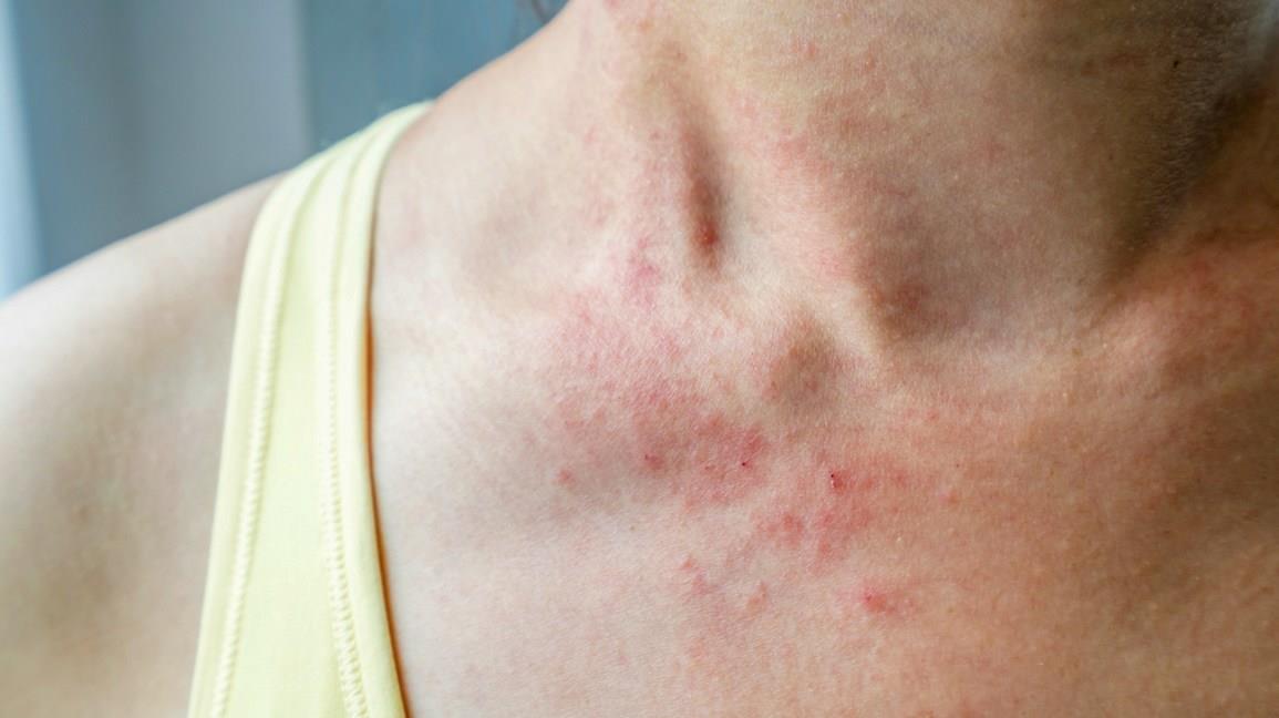 ماذا تعرف عن حساسية عث الغبار؟