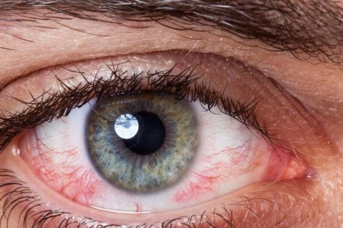 5 أسباب تؤدي لاحمرار العين