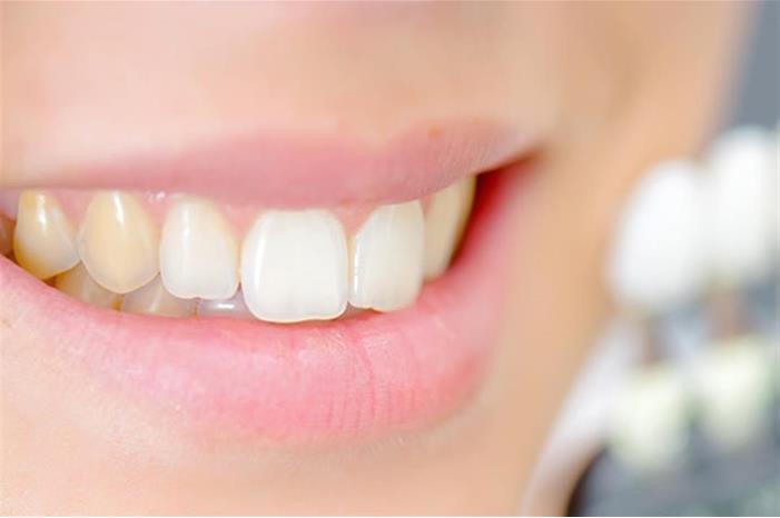 خطأ أثناء تنظيف الأسنان يزيد من اصفرارها
