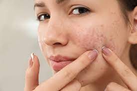 5 عادات سيئة تسبب حب الشباب