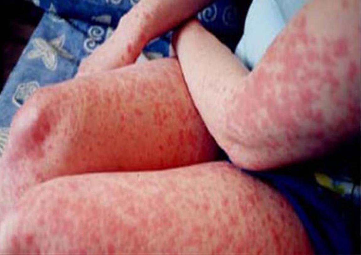 فيروس حمى "النيل الغربي " يهدد الأردن .. وخبير يسأل عن دور مركز مكافحة الأوبئة