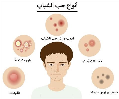 كيفيّة التخلص من حبوب الوجه بسرعة ؟