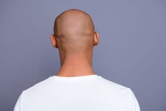 تعرف على العلاج الذي توصل إليه العلماء للصلع الوراثي