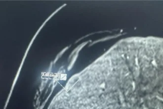الأردن .. أول عملية كي حراري لورم خبيث في الكبد