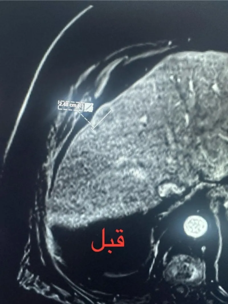 صورة حول : الأردن .. أول عملية كي حراري لورم خبيث في الكبد الأردن .. أول عملية كي حراري لورم خبيث في الكبد