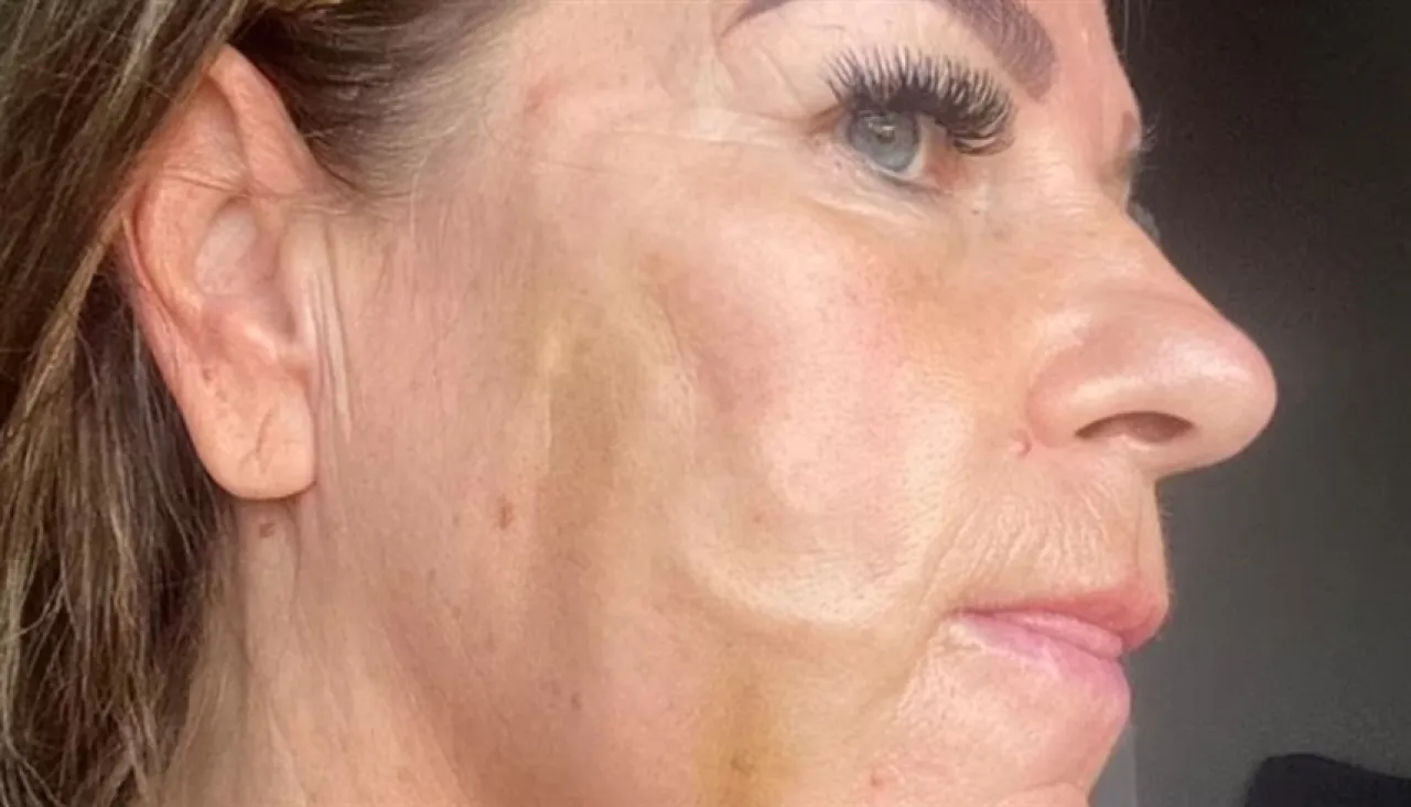 فشل تجميلي يقلب حياة امرأة بريطانية ويجبرها على رحلة علاج