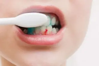 ما سبب نزيف اللثة أثناء فرش الأسنان ؟