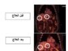 إنجاز طبي جديد بعلاج السرطان في مستشفى الملك المؤسس