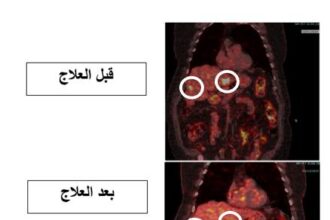 إنجاز طبي جديد بعلاج السرطان في مستشفى الملك المؤسس