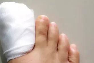 ما بعد استئصال الظفر: تعليمات طبية مهمة لتسريع الشفاء وتجنب المضاعفات