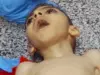 استشهاد طفل بغزة جراء سوء التغذية