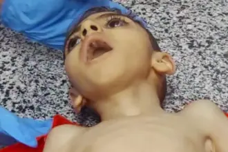 استشهاد طفل بغزة جراء سوء التغذية