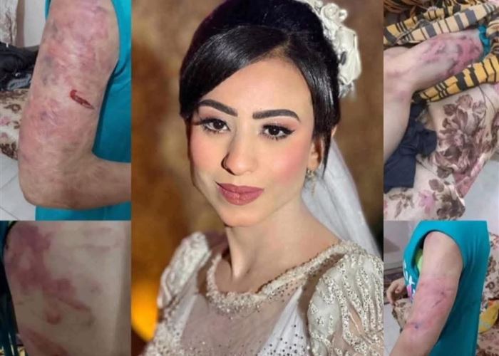 8 ساعات من العذاب.. عروس تتعرض لتعذيب وحشي على يد زوجها في مصر .. صور