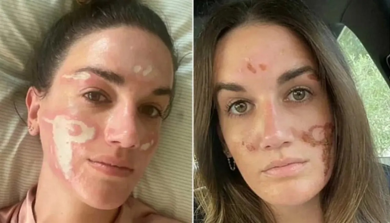 خبيرة تجميل تشوه وجه فتاة وتكلفها 90 ألف دولار