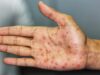 ألمانيا تسجل رقماً قياسياً جديداً في إصابات مرض الزهري