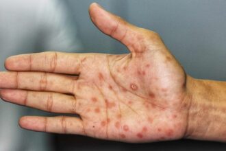ألمانيا تسجل رقماً قياسياً جديداً في إصابات مرض الزهري