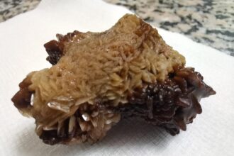 مادبا: عملية نوعية لاستخراج حصوة من الكلى